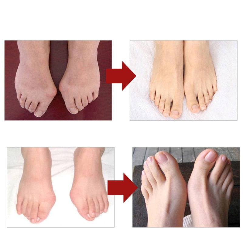 Séparateur d'orteils en silicone | Correcteur Hallux Valgus